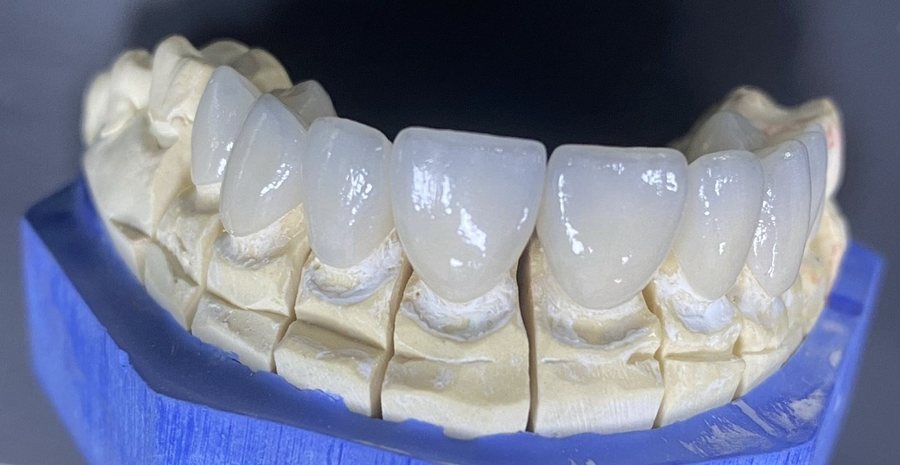 Prettau és full cirkon anyagú fogászati implantátumok előnyei