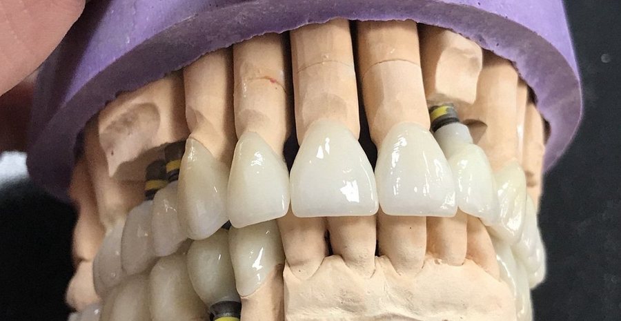 Prettau and full zirconia work on implants: durability and aesthetics