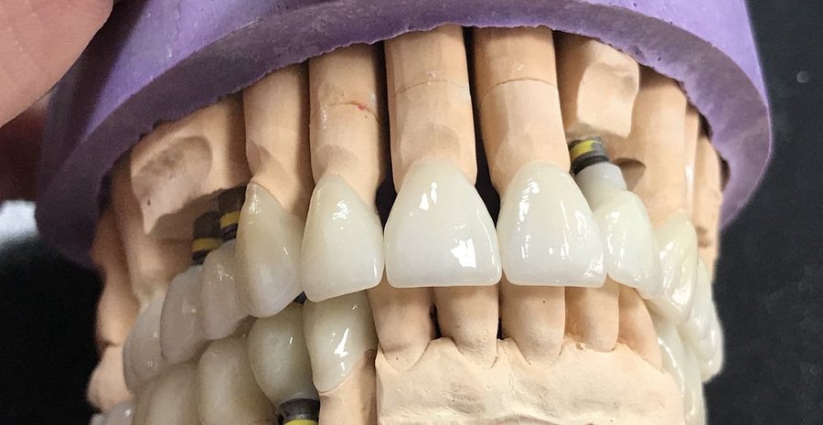 Prettau i pun cirkon radovi na implantatima: trajnost i estetika